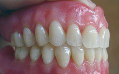 dentista-natal-protese1