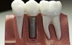 implante-dentario